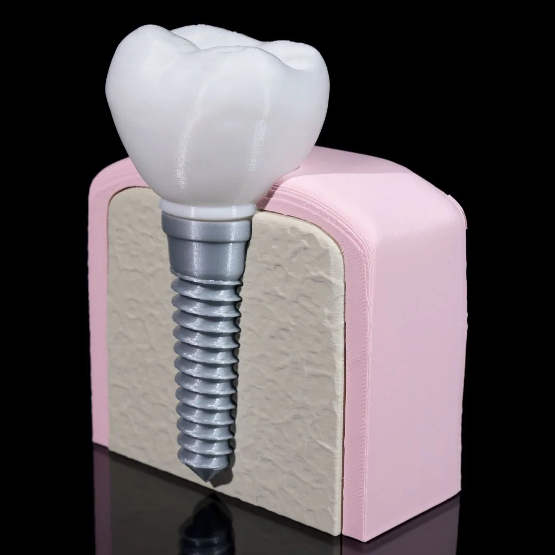 Angled view of a dental implant model showing a crown and screw in a jaw cross-section.