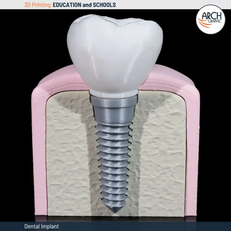 3D printed dental implant educational model