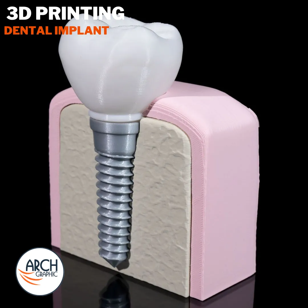 3D printed dental implant model for educational and professional use in UAE and Sharjah