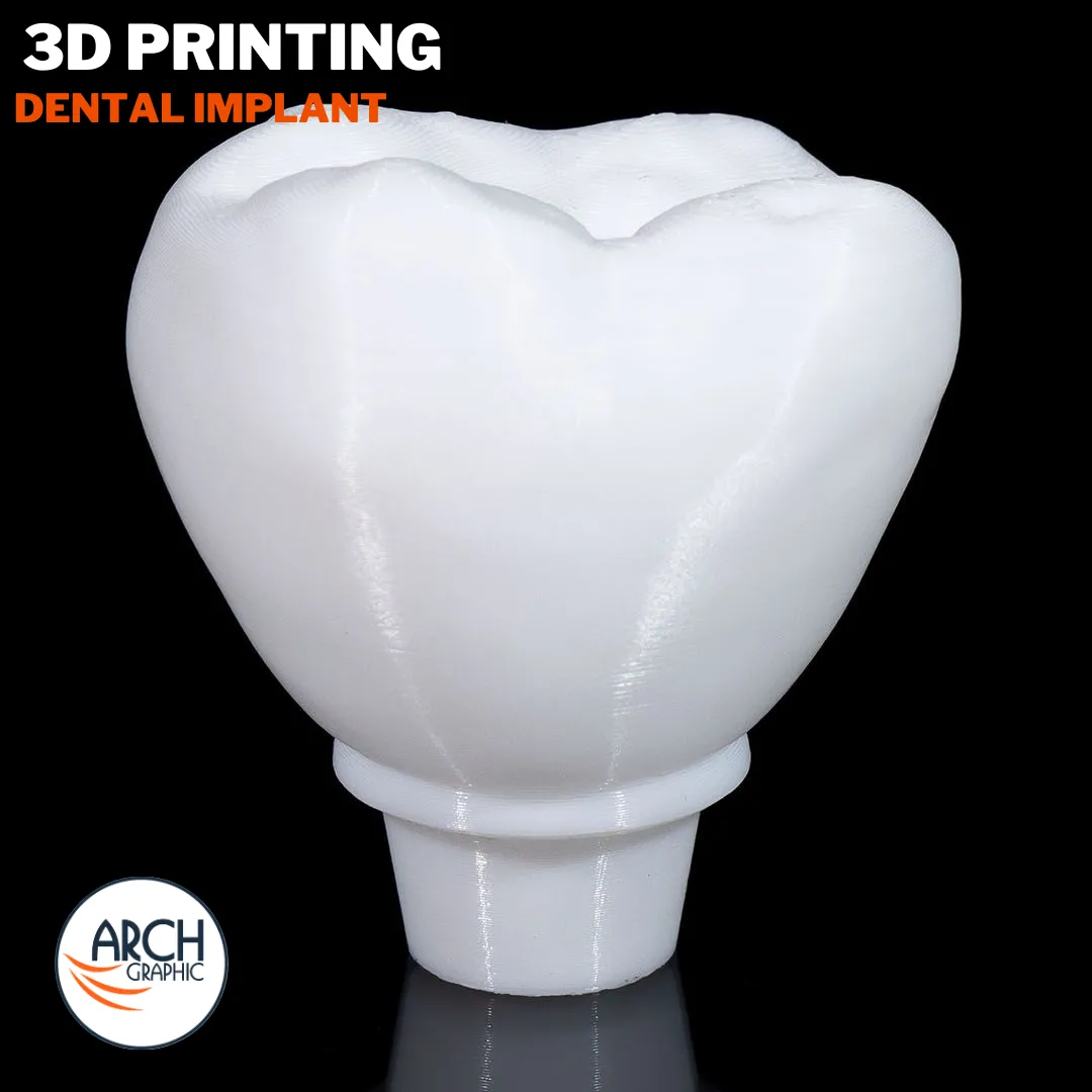 3D printed dental implant model designed for medical training and student projects in UAE